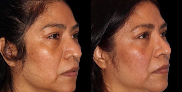 Results Of Open Rhinoplasty In Atlanta ¾ Right View